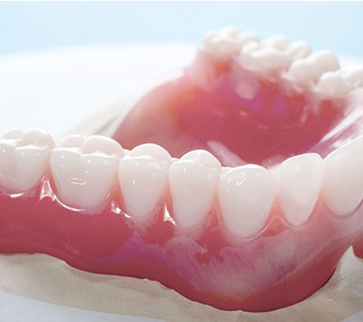 ThermoSens Dentures